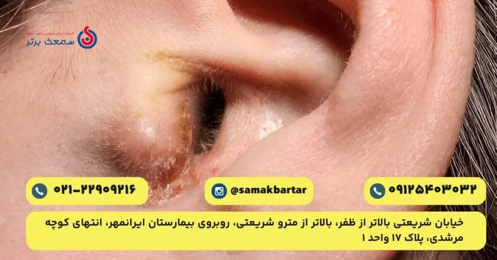 عکس قارچ گوش عفونت قارچی گوش عکس قارچ گوش