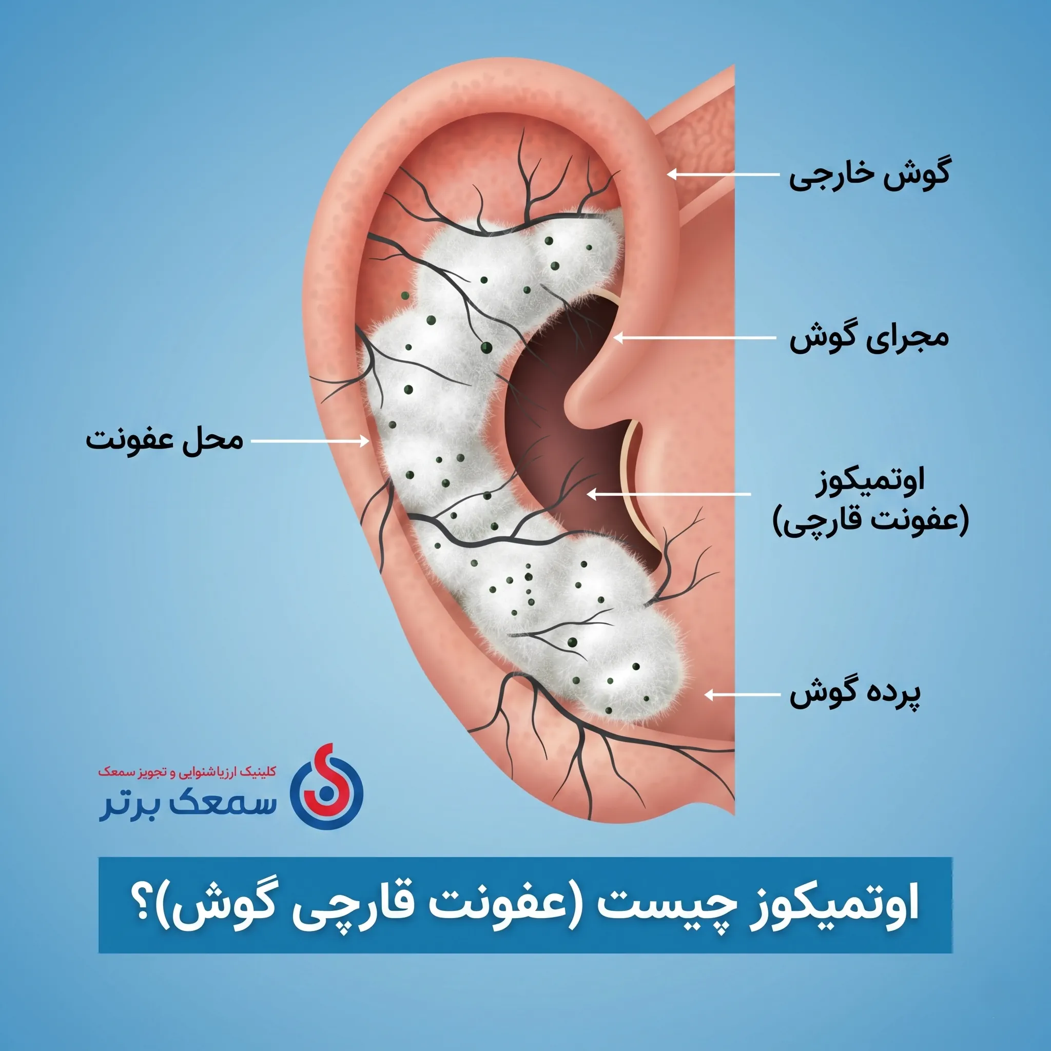 اوتمیکوز یا عفونت قارچی - عکس قارچ گوش
