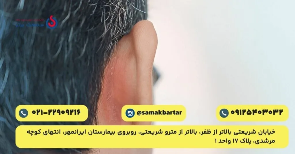 عفونت قارچی گوش عفونت قارچی گوش - عفونت قارچی گوش