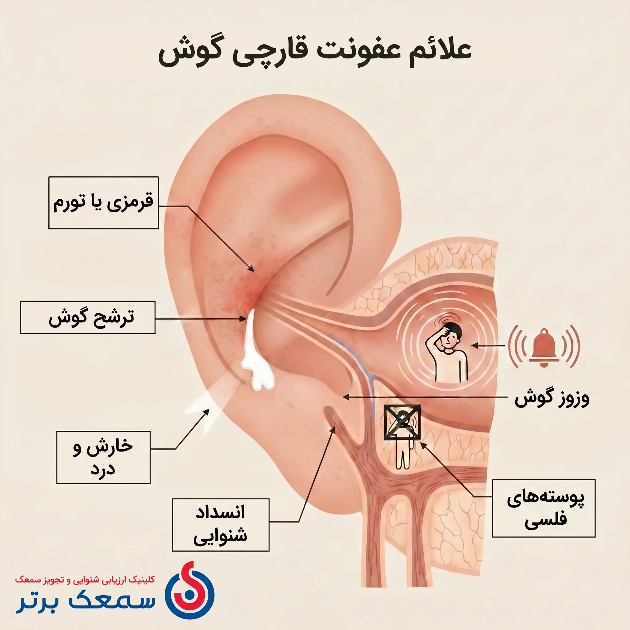 علائم عفونت قارچ گوش - عکس قارچ گوش